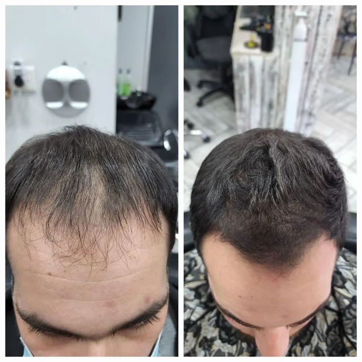 Entdecke das Geheimnis für kräftiges Haarwachstum in deinen 30ern